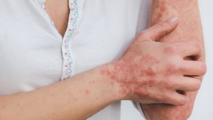 Why Stress Can Make Psoriasis Flare And Why Scratching Makes It Worse