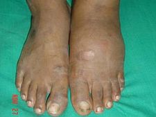 ಮಧುಮೇಹಿಗಳೇ ನಿಮ್ಮ ಕಾಲುಗಳ ಬಗ್ಗೆ ಎಚ್ಚರವಿರಲಿ