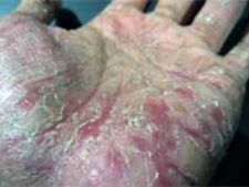 ಚಳಿಗಾಲದಲ್ಲಿ ಬಿರುಕು ಚರ್ಮದ ರಕ್ಷಣೆ ಹೇಗೆ?