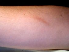 ಶಸ್ತ್ರ ಚಿಕಿತ್ಸೆಯ ಕಲೆ ಮಾಯಮಾಡುವ ಕಲೆ 