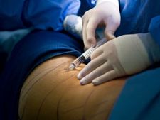 ತೆಳ್ಳಗಾಗಿಸುವ ಲಿಪೊಸಕ್ಷನ್ ಚಿಕಿತ್ಸೆ ಪ್ರಾಣಕ್ಕೆ ಅಪಾಯ!