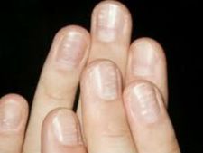 ಉಗುರುಗಳಲ್ಲಿ ಬಿಳಿಚುಕ್ಕಿಗಳಿದ್ದರೆ ಅಪಾಯ!