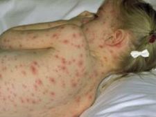 ಬೇಸಿಗೆ ಕಾಲದಲ್ಲಿ ಚಿಕನ್ ಪಾಕ್ಸ್ ಬಗ್ಗೆ ಎಚ್ಚರ