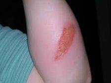 ಸುಟ್ಟ ಗಾಯಗಳಾದಾಗ ಪ್ರಥಮ ಚಿಕಿತ್ಸೆ ಹೀಗಿರಲಿ