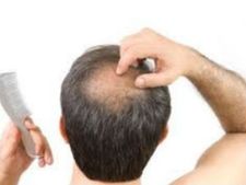 ಬಕ್ಕ ತಲೆ ಉಂಟಾಗದಿರಲು ಈ ರೀತಿ ಮಾಡಿ!