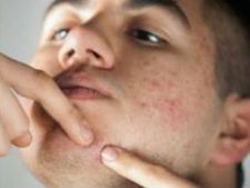 ಮೊಡವೆಯನ್ನು ಮಾಯವಾಗಿಸುತ್ತೆ ಈ ವಿಧಾನ