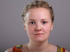 ಮೊಡವೆ ಹೆಚ್ಚಾಗಲೂ ಈ ಆಹಾರಗಳು ಒಂದು ಕಾರಣ