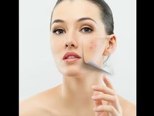 ಮೊಡವೆ ಕಮ್ಮಿಯಾಗಲು ಪಾಲಿಸಬೇಕಾದ ವಿಧಾನಗಳು