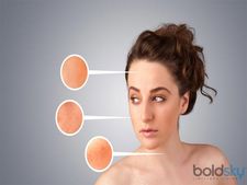 ಹದಿಹರೆಯದಲ್ಲಿ ಕಾಡುವ ಮೊಡವೆಗೆ ಇಲ್ಲಿದೆ ಸೂಕ್ತ ಪರಿಹಾರ!