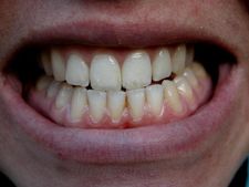 ನೀವು ನಿದ್ದೆಯಲ್ಲಿ ಹಲ್ಲು ಕಡಿಯುತ್ತೀರಾ?