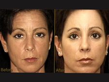 ತಲೆಕೂದಲ ಬೆಳವಣಿಗೆಗಾಗಿ ಅಡ್ವಾನ್ಸ್ ಫ್ಯಾಬ್ರಿನ್ ಮ್ಯಾಟ್ರಿಕ್ಸ್ ಚಿಕಿತ್ಸೆ