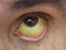 ದೇಹದ ಲಿವರ್ ಹಾನಿಯ ಚಿಹ್ನೆಗಳನ್ನು ಪತ್ತೆ ಹಚ್ಚುವುದು ಹೇಗೆ?