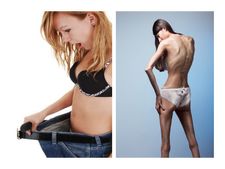 ಮಾನಸಿಕ ರೋಗವಾದ 'ಅನೋರೆಕ್ಸಿಯಾ' ಕಾಯಿಲೆಯ ಲಕ್ಷಣಗಳೇನು?