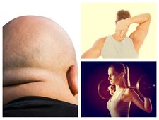 ಕುತ್ತಿಗೆಯ ಸುತ್ತಲಿನ ಬೊಜ್ಜು: ಚಿಂತಿಸಬೇಡಿ ಇಲ್ಲಿದೆ ಸೂಕ್ತ ಪರಿಹಾರ