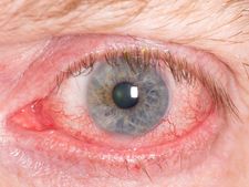 ಕಣ್ಣಿಗೆ ಭಾದೆ ತರುವ ಕೆಂಗಣ್ಣು ರೋಗಕ್ಕೆ ಪರಿಹಾರವೇನು?