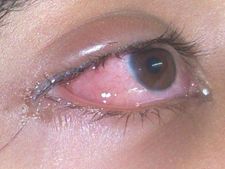 ಎಚ್ಚರ: ಪ್ರಾಣ ಕಂಟಕ 'ಏರಿಳಿತ ಜ್ವರ'ದ ಮೂಲ ಅರಿಯಿರಿ! 