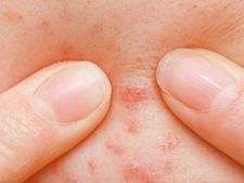 ಅಮೃತದಂತಹ ಮದ್ದಿರುವಾಗ ಮೊಡವೆಗೆ ಅಂಜುವುದೇಕೆ?