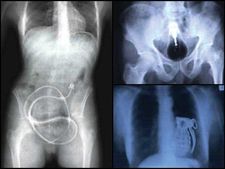 ಅಚ್ಚರಿಯ ಜಗತ್ತು: ಇವರು ಕೈಗೆ ಸಿಕ್ಕಿದನ್ನೆಲ್ಲಾ ತಿಂದು ಬಿಡುತ್ತಾರೆ!  