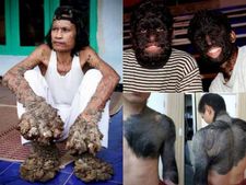 ವಿಚಿತ್ರ ಕಾಯಿಲೆಗಳು-ನೆನೆಸಿಕೊಂಡರೇ ಭಯವಾಗುತ್ತದೆ..! 