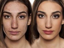 ಒಂದೇ ವಾರದಲ್ಲಿ ಮುಖದಲ್ಲಿನ ಮೊಡವೆಗಳು ಮಂಗಮಾಯ!  