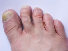 ಕಾಲ್ಬೆರಳ ಉಗುರು ಶಿಲೀಂಧ್ರಕ್ಕೆ ಫಲಪ್ರದ ಮನೆಮದ್ದು  