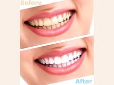 ಹಲ್ಲುಗಳು ಬಿಳಿ ಇಲ್ಲವೆಂಬ ಚಿಂತೆಯೇ? ಇಲ್ಲಿದೆ ಸರಳ ಟಿಪ್ಸ್...