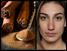 ಬ್ಯೂಟಿ ಟಿಪ್ಸ್: ಮುಖದ ಅಂದಕ್ಕೆ-ದಾಲ್ಚಿನ್ನಿ ಫೇಸ್ ಪ್ಯಾಕ್ 