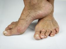 ಒಡೆದ ಹಿಮ್ಮಡಿ ಸಮಸ್ಯೆಗೆ, ಫಟಾಫಟ್ ಟಿಪ್ಸ್-ಒಮ್ಮೆ ಪ್ರಯತ್ನಿಸಿ