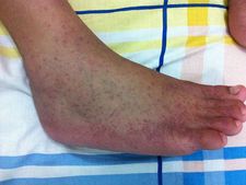 ಚಿಕೂನ್ ಗುನ್ಯಾ ಜ್ವರ- ಪ್ರತಿಯೊಬ್ಬರೂ ತಿಳಿದಿರಬೇಕಾದ ಸಂಗತಿಗಳು