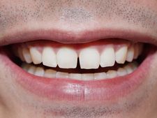 ಮುಂದಿನ ಹಲ್ಲುಗಳ ನಡುವಿನ ಅಂತರ, ಅದೃಷ್ಟದ ಸಂಕೇತ!  