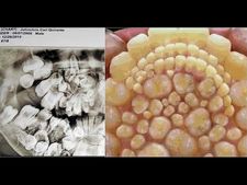 ವೈದ್ಯರಿಗೇ ಶಾಕ್!! ಇವನ ಬಾಯಲ್ಲಿ ಬರೋಬ್ಬರಿ 232 ಹಲ್ಲುಗಳು ಇತ್ತು!   