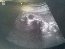 ಭಯ ಹುಟ್ಟಿಸುವ ಆ ಅಲ್ಟ್ರಾಸೌಂಡ್ ಸ್ಕ್ಯಾನ್ ಚಿತ್ರಗಳು!! 