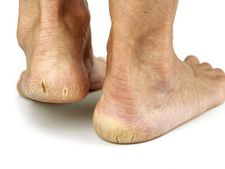 ಹಿಮ್ಮಡಿ ಕಾಲು ಒಡೆದಿದ್ರೆ, ಒಮ್ಮೆ ಈ ಮನೆಮದ್ದುಗಳನ್ನು ಪ್ರಯತ್ನಿಸಿ ನೋಡಿ... 