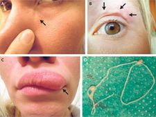 ಅಚ್ಚರಿಯ ಜಗತ್ತು: ಮಹಿಳೆಯ ಚರ್ಮದೊಳಗೆ ಜೀವಂತ ಹುಳು!