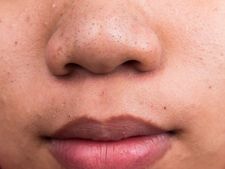 ಮೂಗಿನ ಮೇಲಿರುವ ಕಪ್ಪು ಕಲೆಗಳ ನಿವಾರಣೆಗೆ ಇಲ್ಲಿದೆ ನೋಡಿ ಸರಳ ಮನೆಮದ್ದುಗಳು