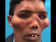 ಸಿಂಹ ಮುಖ ಹೊಂದಿದ್ದ ವ್ಯಕ್ತಿ, ಸರ್ಜರಿ ನಂತರ ಮತ್ತೆ ಸಾಮಾನ್ಯನಾದ ಸ್ಟೋರಿ ಇದು 