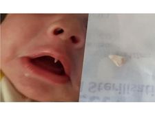 ರಾತ್ರಿ ಬೆಳಗಾಗುವುದರೊಳಗೆ ಮಗುವಿನ ಬಾಯಿಯಲ್ಲಿ ಮೂಡಿದ ಕೋರೆ ಹಲ್ಲು!