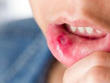 ತುಟಿಗಳ ಕ್ಯಾನ್ಸರ್ ವಿರುದ್ಧ ಹೋರಾಡುವ ನೈಸರ್ಗಿಕ ಆಹಾರಗಳು    