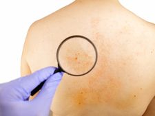 ಸಲಿಂಗಿ ಪುರುಷರಲ್ಲಿ ಹೆಚ್ಚಾಗಿ ಕಂಡುಬರುವ ಈ 'ಸಿಫಿಲಿಸ್' ಕಾಯಿಲೆ, ಈಗ ಮಹಿಳೆಯರಿಗೂ ಕಾಡತೊಡಗಿದೆ! 