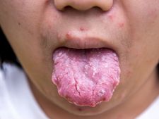 ನಾಲಿಗೆಯ ಕ್ಯಾನ್ಸರ್-ನೀವು ತಿಳಿಯಲೇಬೇಕಾದ ಸಂಗತಿಗಳು