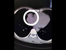 ಕುಡಿದ ಮತ್ತಿನಲ್ಲಿ ಟೂಥ್ ಪಿಕ್‌ನ್ನೇ ನುಂಗಿದ! ಅದು ಹೃದಯದಲ್ಲಿ ಸಿಲುಕಿತು!  