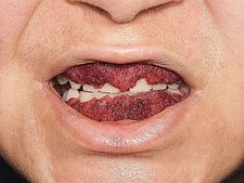 ಅಚ್ಚರಿಯ ಜಗತ್ತು: ಸ್ಟ್ರಾಬೆರಿಯಂತೆ ಕಾಣಿಸುವ ಮಹಿಳೆಯ ಒಸಡುಗಳು!!