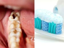 ಮಕ್ಕಳಿಗೆ ಹಲ್ಲಿನ ಸೋಂಕು: ಲಕ್ಷಣಗಳು ಮತ್ತು ಅದನ್ನು ತಡೆಯುವ ವಿಧಾನಗಳು