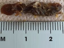 ಕಿವಿಯಿಂದ ದೊಡ್ಡ ಗಾತ್ರದ ಮೇಣ ಹೊರತೆಗೆದ ವಿಡಿಯೋ ವೈರಲ್! 