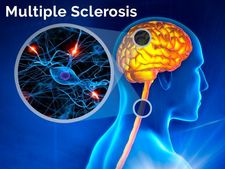 ಮಲ್ಟಿಪಲ್ ಸ್ಕ್ಲೆರೋಸಿಸ್: ಕಾರಣಗಳು, ಲಕ್ಷಣಗಳು, ಪತ್ತೆ ಹಚ್ಚುವಿಕೆ ಮತ್ತು ಚಿಕಿತ್ಸೆ