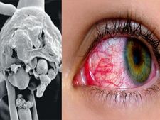 ಮಕ್ಕಳು ಬ್ಲಾಕ್ ಫಂಗಸ್ ಸೋಂಕಿಗೆ ತುತ್ತಾಗುವ ಸಾಧ್ಯತೆ ಎಷ್ಟಿದೆ?