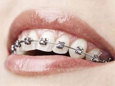 ಹಲ್ಲುಗಳಿಗೆ ಕ್ಲಿಪ್ ಹಾಕಿಸಿಕೊಂಡವರು ಈ ವಿಚಾರಗಳನ್ನು ನೆನಪಿನಲ್ಲಿಡಿ