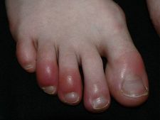 ಕೊರೊನಾದಿಂದ ಕೈ-ಕಾಲಿನ ಬೆರಳುಗಳಲ್ಲಿ ಊತ: ಏನಿದು ಕೊರೊನಾದ ಹೊಸ ಪರಿಣಾಮ?