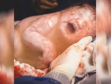 ಸೃಷ್ಟಿಯ ಅಚ್ಚರಿ: ಕಾಶ್ಮೀರದಲ್ಲಿ ಗರ್ಭಚೀಲದೊಂದಿಗೆ ಮಗು ಜನನ