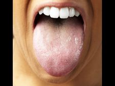 ಬಿಳುಚಿಕೊಂಡ ನಾಲಿಗೆ ನೀಡುತ್ತದೆ ಅರೋಗ್ಯದ ಬಗ್ಗೆ ಆಪಾಯದ ಮುನ್ಸೂಚನೆ 